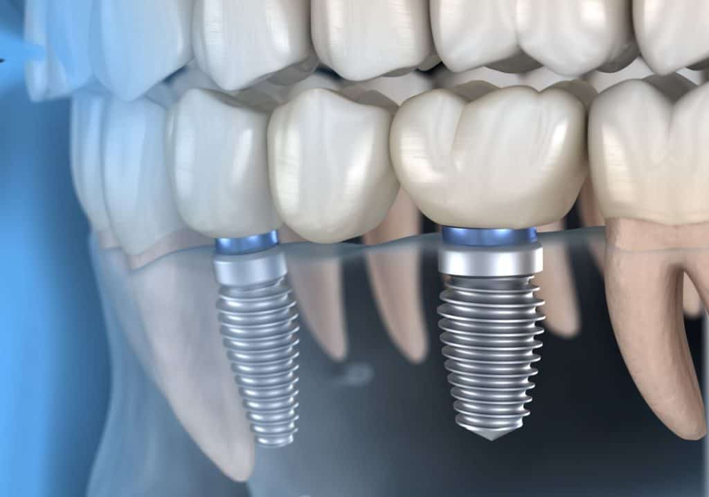 implante dental